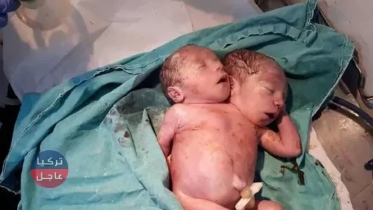 ولادة طفل سوري برأسين في ريف إدلب شمالي سوريا