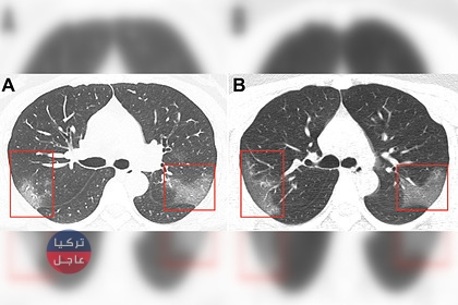 شاهد ماذا يفعل فيروس كورونا بالرئتين .. صورة تبث لأول مرة