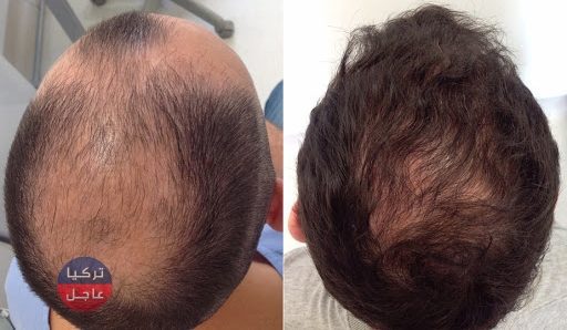 الكشف عن عوامل طبيعية لاعادة انبات الشعر في غضول أشهر