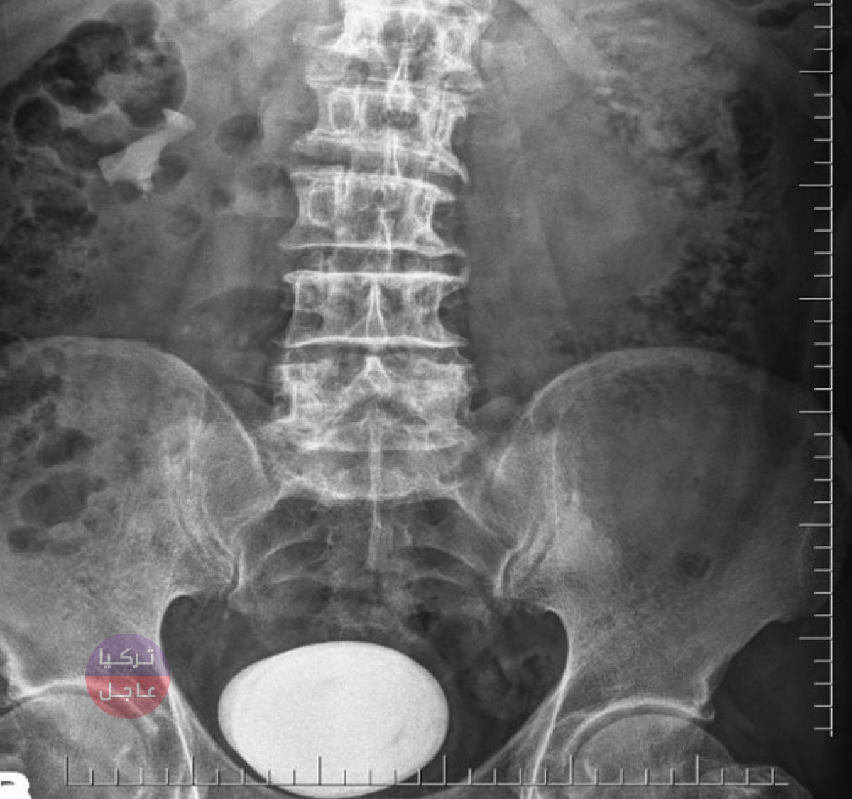 إزالة حصوة بحجم حبة البطاطس من مثانة مواطن تركي إزالة حصوة بحجم حبة البطاطس من مثانة مواطن تركي