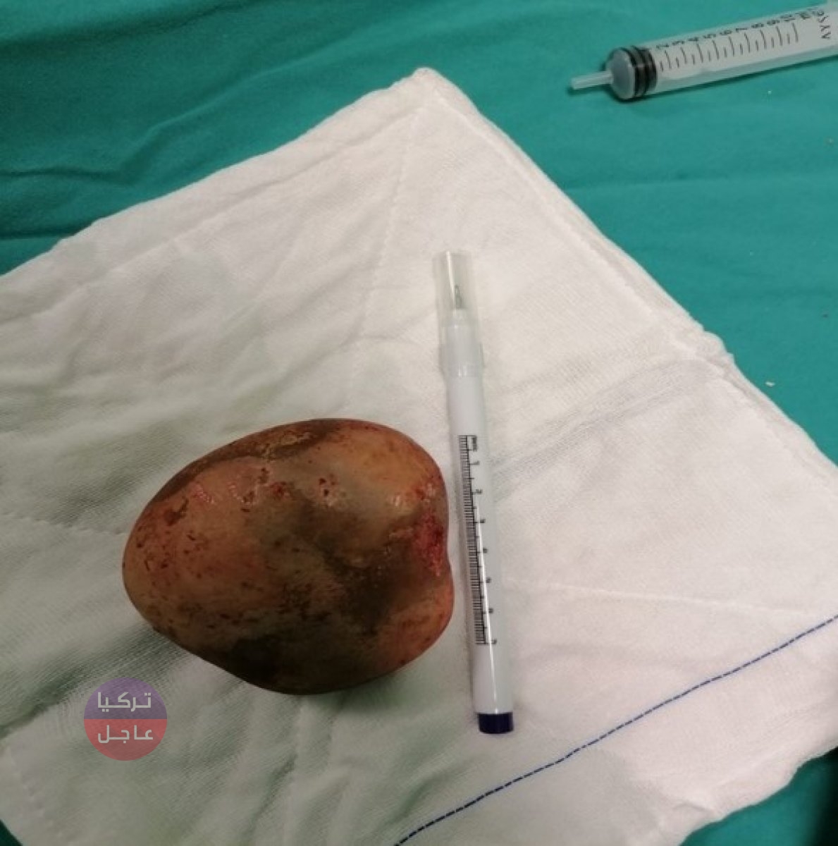 إزالة حصوة بحجم حبة البطاطس من مثانة مواطن تركي إزالة حصوة بحجم حبة البطاطس من مثانة مواطن تركي