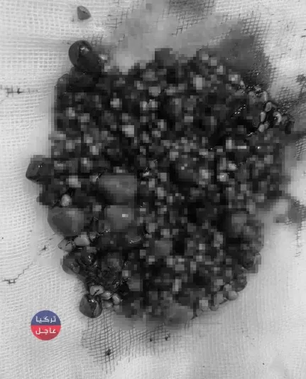 لن تصدق ماذا خرج من بطن امرأة بعدما عانت من آلام قوية