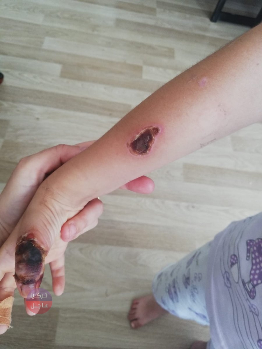 حرق يد طفلة صغيرة حتى العظم أثناء التصوير بالرنين المغناطيسي في اسطنبول حرق يد طفلة صغيرة حتى العظم أثناء التصوير بالرنين المغناطيسي في اسطنبول