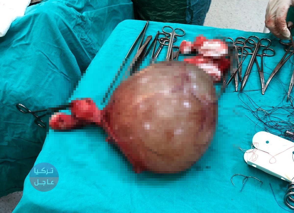 امرأة تعاني من ضيق التنفس ما خرج من بطنها كان مرعبا امرأة تعاني من ضيق التنفس ما خرج من بطنها كان مرعبا