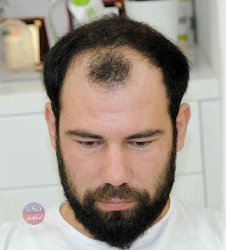 زين الدين زيدان في تركيا من أجل زراعة الشعر زين الدين زيدان في تركيا من أجل زراعة الشعر