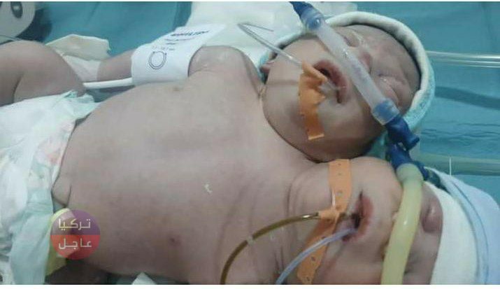 انفصلا عند الصدر وتشكل رأسين! ولادة طفل برأسين في مدينة إدلب السورية انفصلا عند الصدر وتشكل رأسين! ولادة طفل برأسين في مدينة إدلب السورية