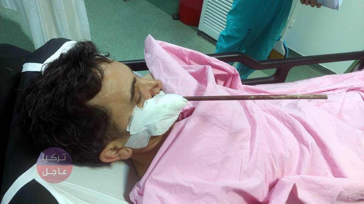 شاهد بالصور وصور الأشعة! نجاح عملية اخراج سيخ حديدي دخل في وجه أحد العمال شاهد بالصور وصور الأشعة! نجاح عملية اخراج سيخ حديدي دخل في وجه أحد العمال