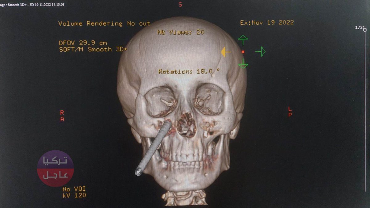 شاهد بالصور وصور الأشعة! نجاح عملية اخراج سيخ حديدي دخل في وجه أحد العمال شاهد بالصور وصور الأشعة! نجاح عملية اخراج سيخ حديدي دخل في وجه أحد العمال