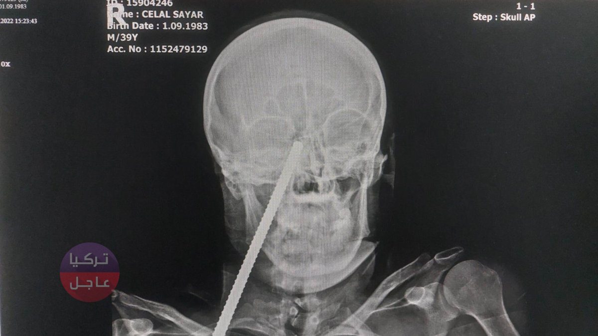 شاهد بالصور وصور الأشعة! نجاح عملية اخراج سيخ حديدي دخل في وجه أحد العمال شاهد بالصور وصور الأشعة! نجاح عملية اخراج سيخ حديدي دخل في وجه أحد العمال