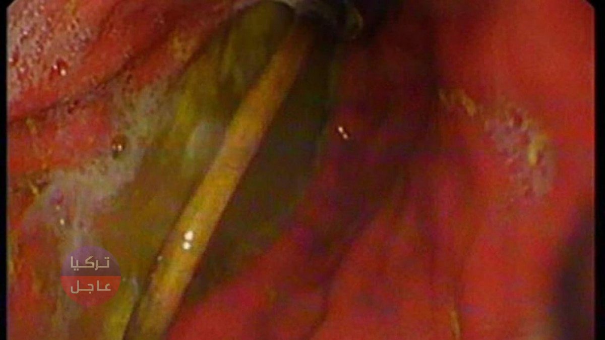 أحد أطرافه انتقل الى الأمعاء وصدمة للطبيب عندما شاهد الصورة الشعاعية! شاهد ما وجدوا في معدة صبي صغير