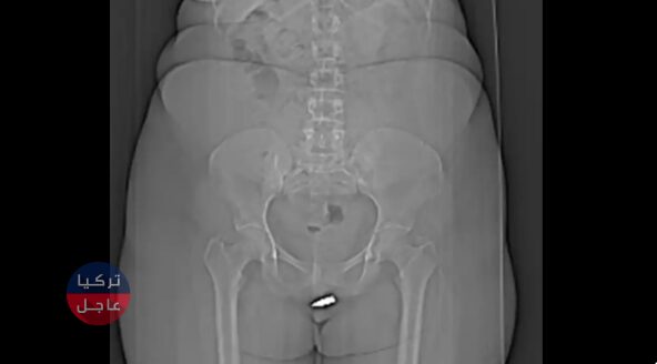 إزالة رصاصة من بظـ ـر امرأة صومالية في أول إصابة من نوعها في العالم