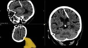 اكتشاف إبرة في دماغ امرأة عمرها يفوق 80 عاما يثير الدهشة والتعجب اكتشاف إبرة في دماغ امرأة عمرها يفوق 80 عاما يثير الدهشة والتعجب