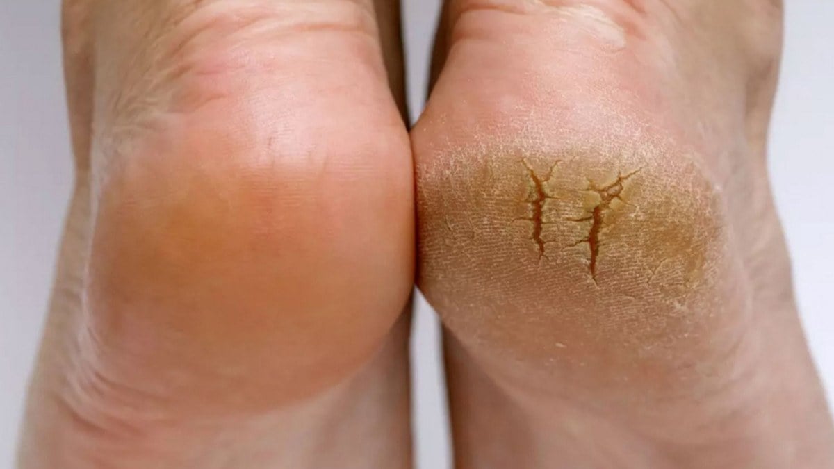 ضعي ملعقة واحدة قبل النوم وستشعرين بكعب قدمك وكأنه قطن