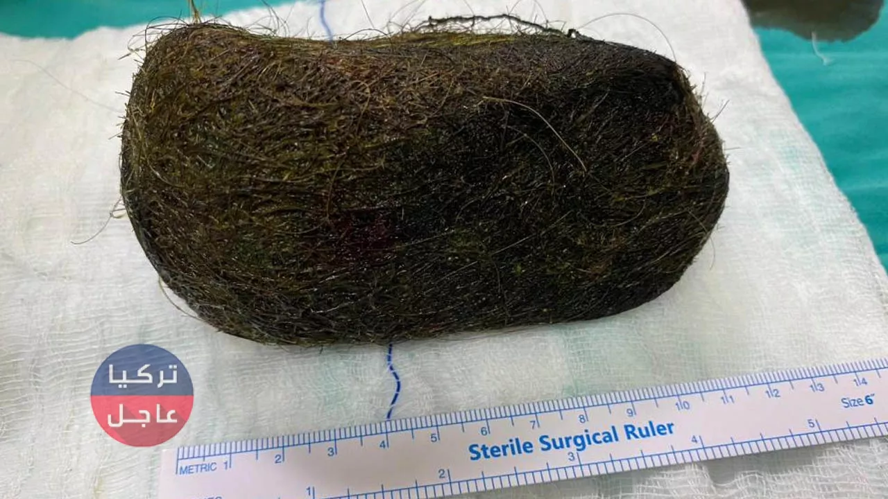 استخراج 2 كيلوغرام شعر من معدة وأمعاء امرأة (شاهد)