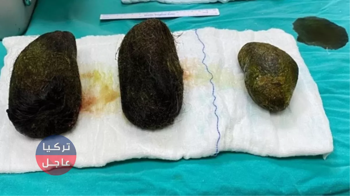 استخراج 2 كيلوغرام شعر من معدة وأمعاء امرأة (شاهد)