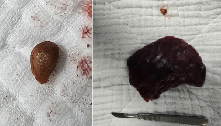 نواة كرز أسود تتلف رئة سيدة مسنة وتؤدي لاستئصال جزء منها في تركيا!