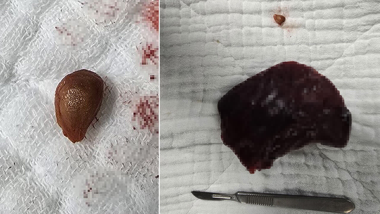 نواة كرز أسود تتلف رئة سيدة مسنة وتؤدي لاستئصال جزء منها في تركيا!