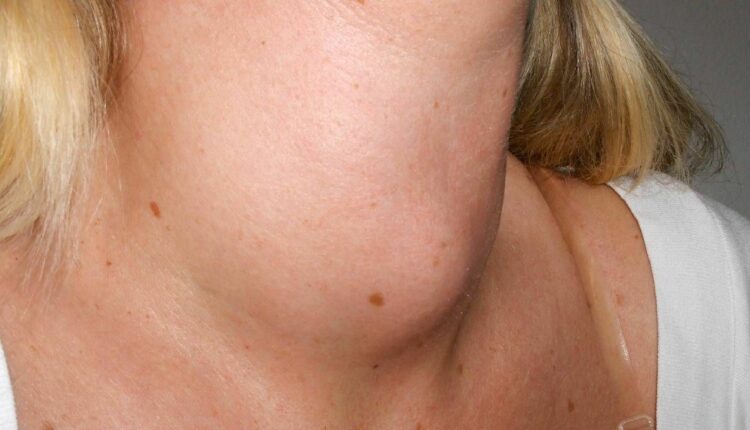 عاجل : تورم الرقبة قد يخفي مرضاً خطيراً… الأطباء يحذرون من تجاهل هذه العلامة