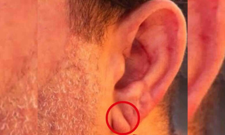 بعد جدل صورة جيم يلماظ.. جراح قلب تركي يوضح حقيقة "خط الأذن"