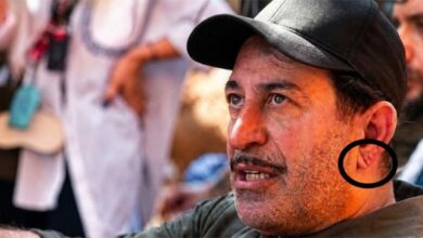 خط شحمة الأذن ليس مؤشراً على النوبة القلبية.. استشاري تركي يوضح
