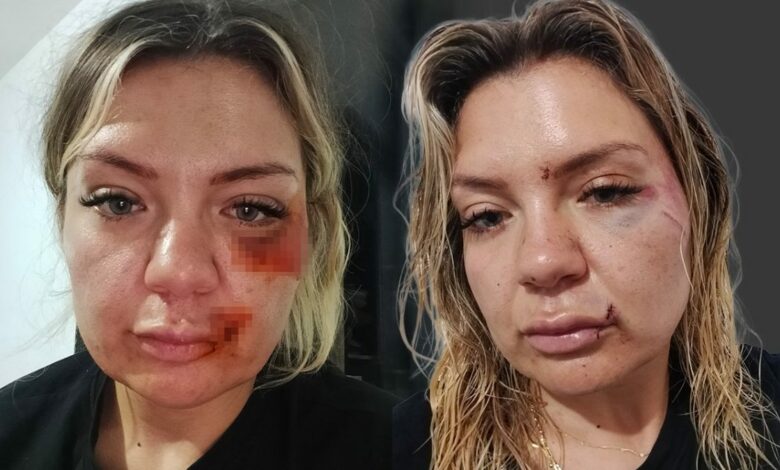 انكسر نصل السكين أثناء طعنها.. النيابة التركية تطلب محاكمة مهاجم امرأة بتهمة محاولة القتل