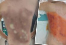 إحراق طفل بالكولونيا على يد أقرانه في إسطنبول التركية.. وفقدانه وعيه بعد خروجه من المستشفى