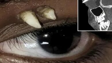 سنّ ناب يتكوّن من عظم محجر عين فتى هندي.. والأطباء: الحالة الأولى من نوعها