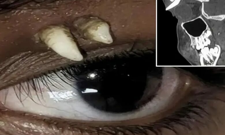 سنّ ناب يتكوّن من عظم محجر عين فتى هندي.. والأطباء: الحالة الأولى من نوعها